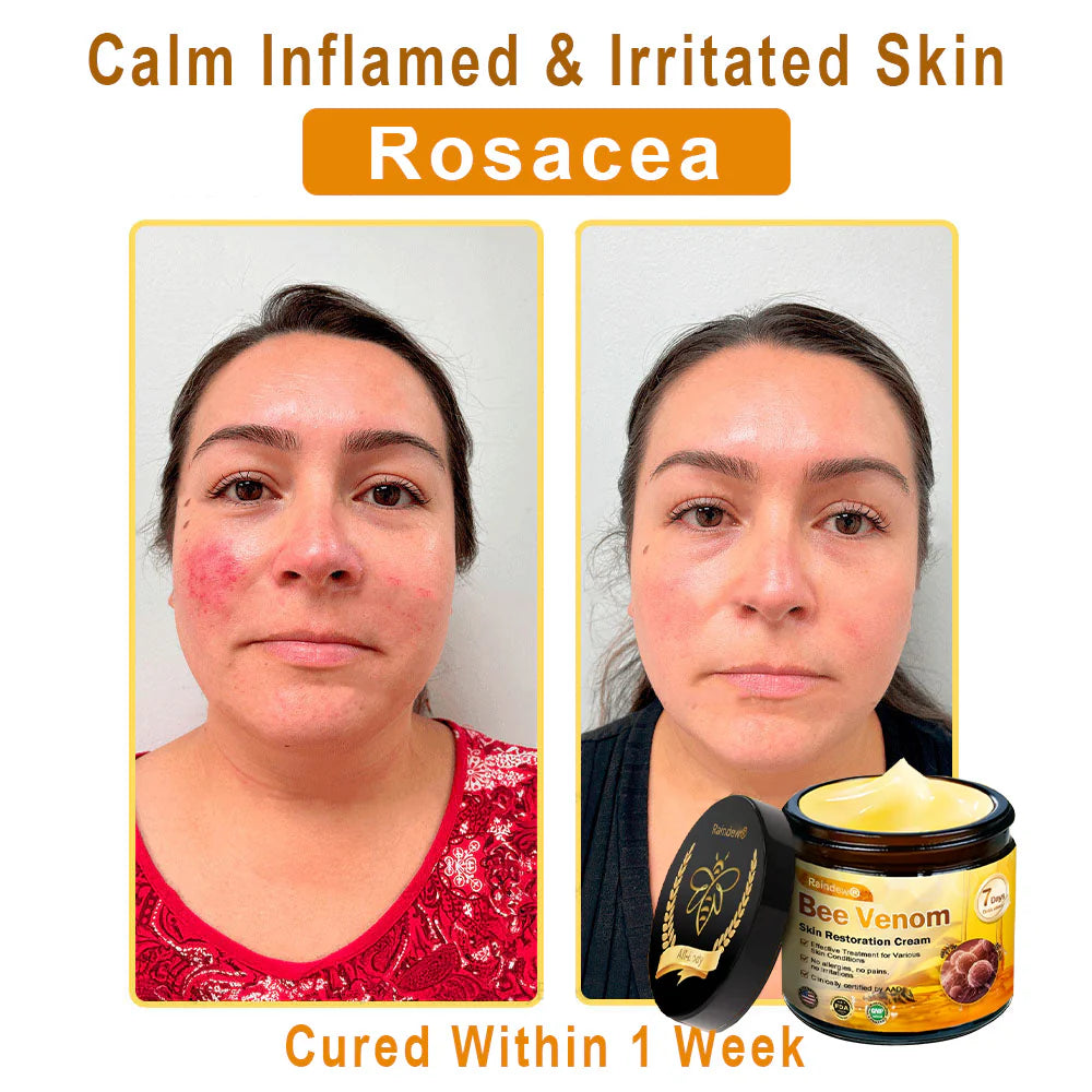 Raindew® Skin Treatment Cream Anti-aging, Hydrating, Skin Repair, Even Tone, Acne and Dark Spot Treatment, Wart and Mole Removal, Psoriasis Relief