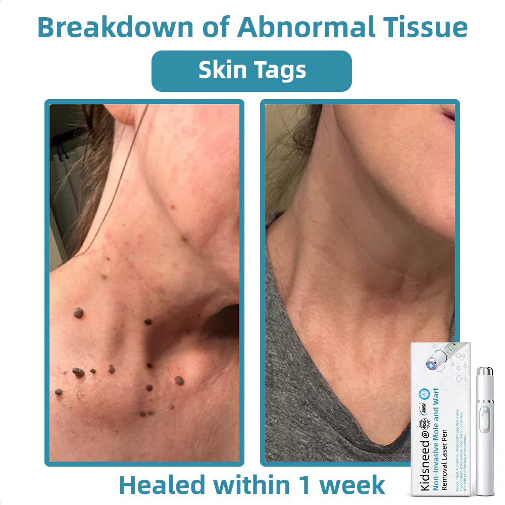 Total Skin Confidence Starts Here💫𝗞ı𝗱s𝗻𝗲𝗲𝗱® 𝗡𝗼𝗻-𝗜𝗻𝘃𝗮𝘀𝗶𝘃𝗲 𝗠𝗼𝗜𝗲 𝗮𝗻𝗱 𝗪𝗮𝗿𝘁 𝗥𝗲𝗺𝗼𝘃𝗮𝗜 𝗜𝗮𝘀𝗲𝗿 𝗣𝗲𝗻👨‍⚕️Developed by the American Academy of Dermatology Association (AAD)