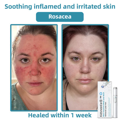 Total Skin Confidence Starts Here💫𝗞ı𝗱s𝗻𝗲𝗲𝗱® 𝗡𝗼𝗻-𝗜𝗻𝘃𝗮𝘀𝗶𝘃𝗲 𝗠𝗼𝗜𝗲 𝗮𝗻𝗱 𝗪𝗮𝗿𝘁 𝗥𝗲𝗺𝗼𝘃𝗮𝗜 𝗜𝗮𝘀𝗲𝗿 𝗣𝗲𝗻👨‍⚕️Developed by the American Academy of Dermatology Association (AAD)