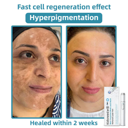 Total Skin Confidence Starts Here💫𝗞ı𝗱s𝗻𝗲𝗲𝗱® 𝗡𝗼𝗻-𝗜𝗻𝘃𝗮𝘀𝗶𝘃𝗲 𝗠𝗼𝗜𝗲 𝗮𝗻𝗱 𝗪𝗮𝗿𝘁 𝗥𝗲𝗺𝗼𝘃𝗮𝗜 𝗜𝗮𝘀𝗲𝗿 𝗣𝗲𝗻👨‍⚕️Developed by the American Academy of Dermatology Association (AAD)