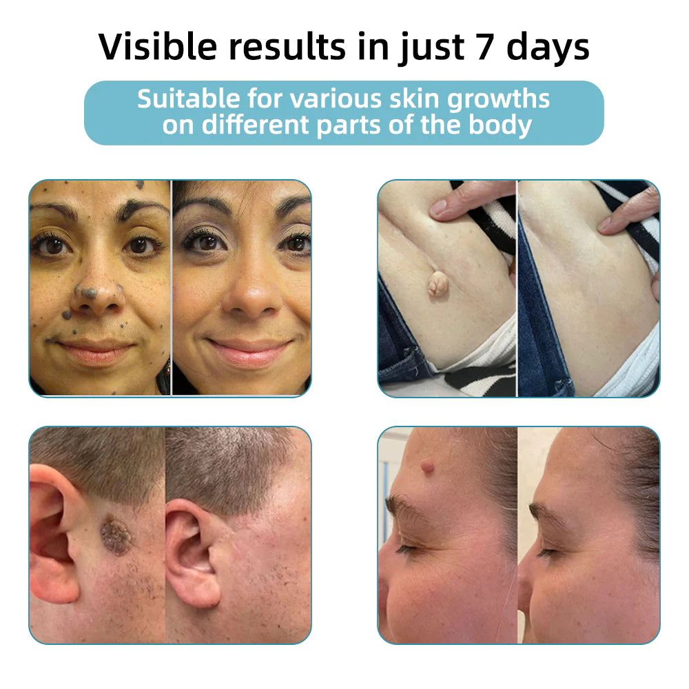 Total Skin Confidence Starts Here💫𝗞ı𝗱s𝗻𝗲𝗲𝗱® 𝗡𝗼𝗻-𝗜𝗻𝘃𝗮𝘀𝗶𝘃𝗲 𝗠𝗼𝗜𝗲 𝗮𝗻𝗱 𝗪𝗮𝗿𝘁 𝗥𝗲𝗺𝗼𝘃𝗮𝗜 𝗜𝗮𝘀𝗲𝗿 𝗣𝗲𝗻👨‍⚕️Developed by the American Academy of Dermatology Association (AAD)